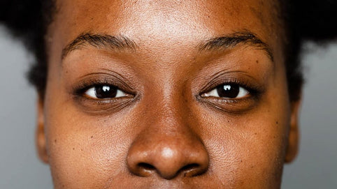 Hyperpigmentation peau noire: qu’est-ce que c’est et comment y faire face?